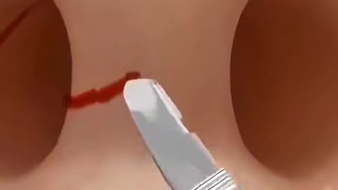 086 - Rhinoplasty Surgery – Nose Reshaping for Better Breathing & Aesthetic Look - 3d