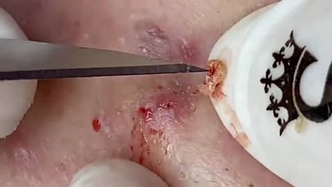 PIMPLE POPPING 1