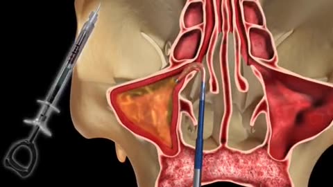 Balloon sinus Surgery 3D Animation (Balloon Sinuplasty)