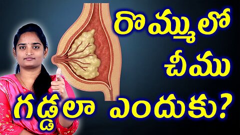 రొమ్ములో చీము గడ్డలా Breast Infection Types Symptoms | Causes For Breast Abcess Homeopathy Medicine
