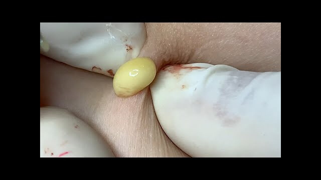 INSANE Blackhead Removals You Won’t Believe!