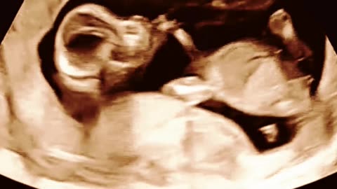 Unlock Parenthood: IUI Treatment at Sumathi Hospital