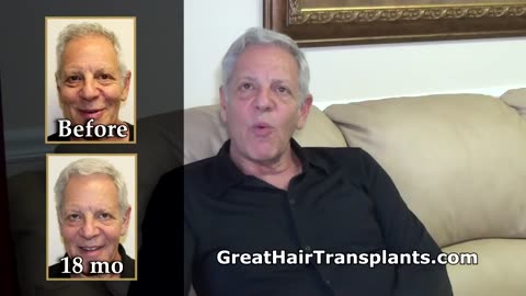 Amazing Hair Restoration Testimonial by Dr. Brett Bolton’s Patient