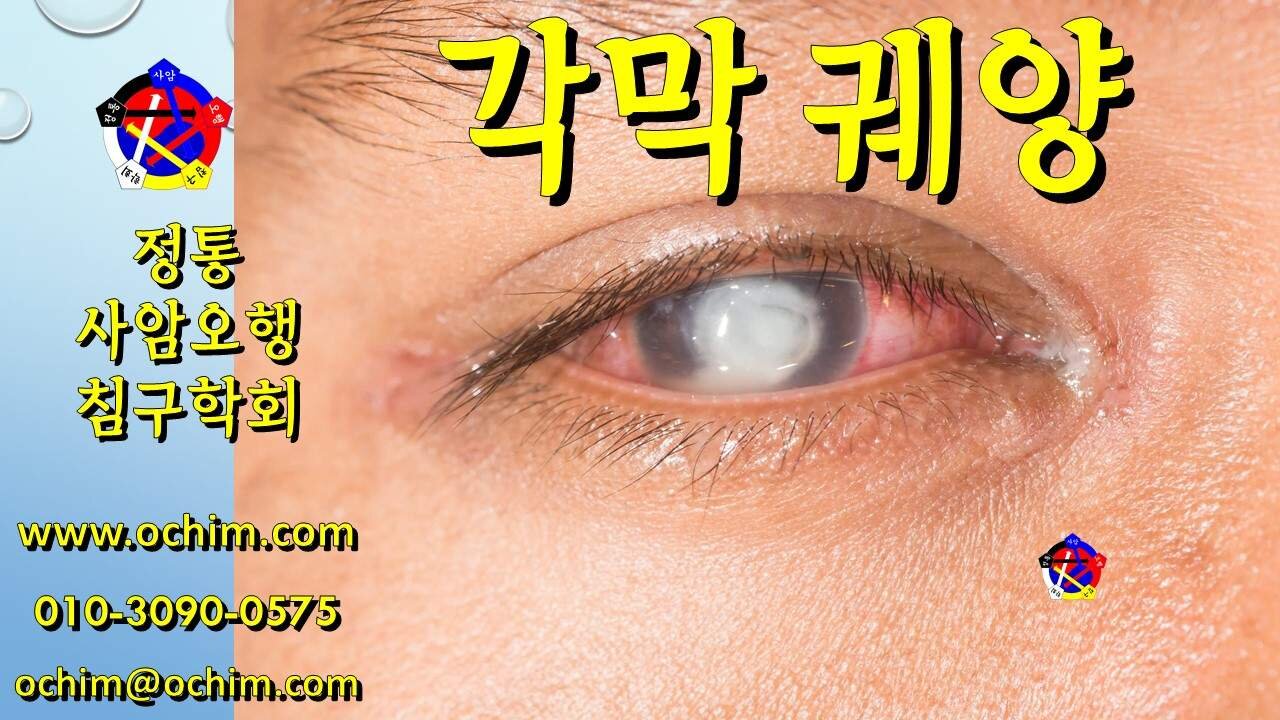 각막 궤양 치료 방법 - 사암오행침, 사암침법, 오행침, 정통사암침