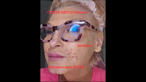 Cross hatch Pattern Juveface ACECOSM DIY55 Nasalabial