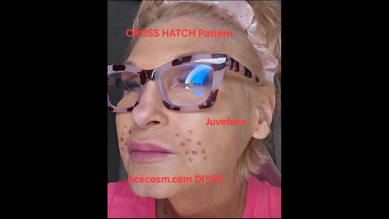 Cross hatch Pattern Juveface ACECOSM DIY55 Nasalabial