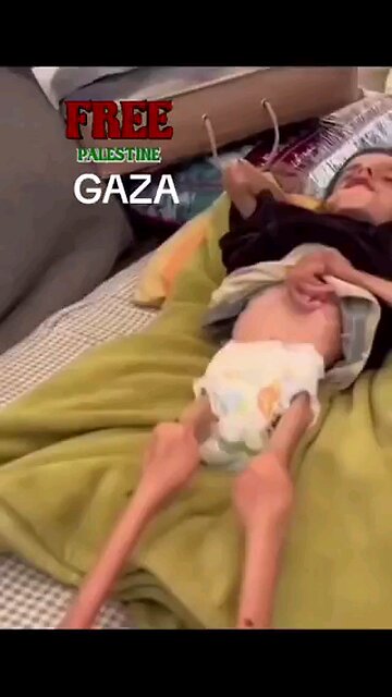 starving Gaza children Isreal did this