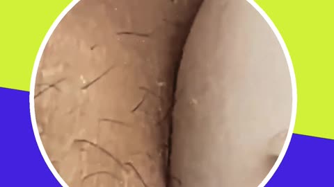 Blackhead removal new this week (ASMR) #16 #shorts