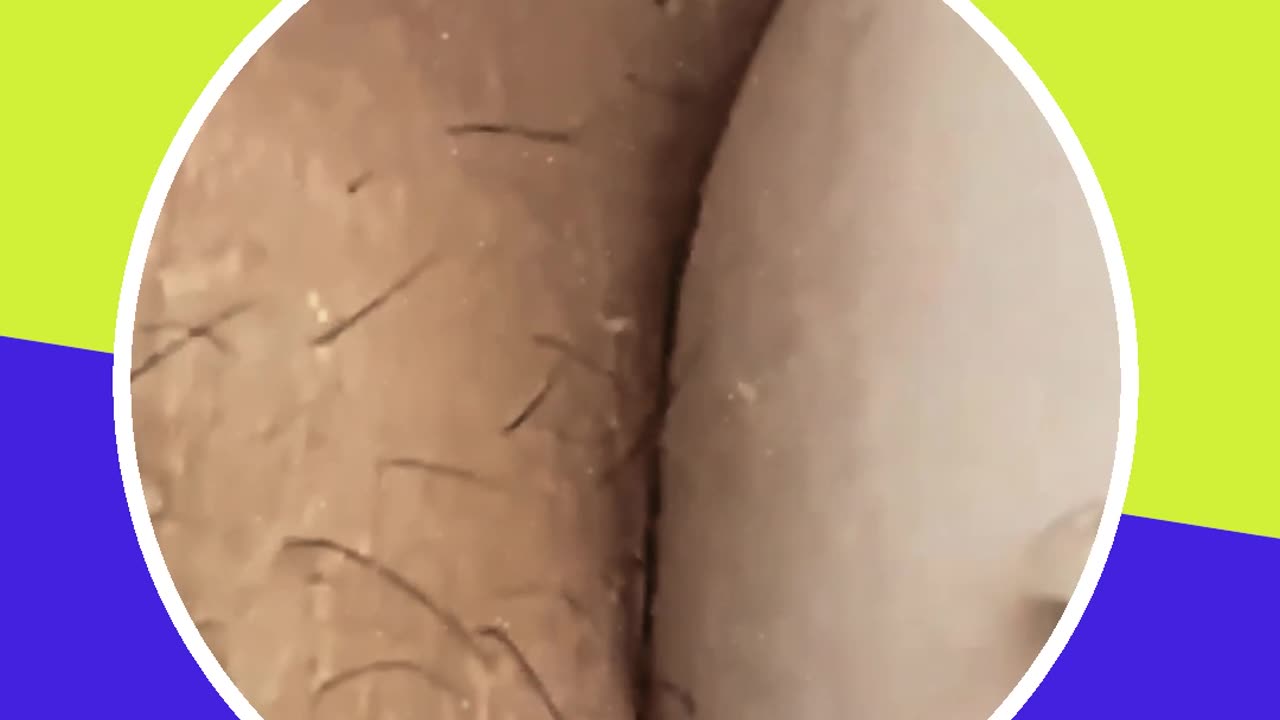 Blackhead removal new this week (ASMR) #16 #shorts