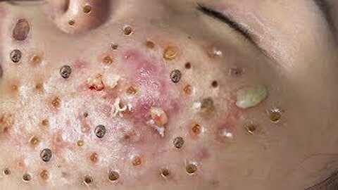 Deep Blackhead Removal on Face | Satisfying Pimple Popping & Skin Cleaning