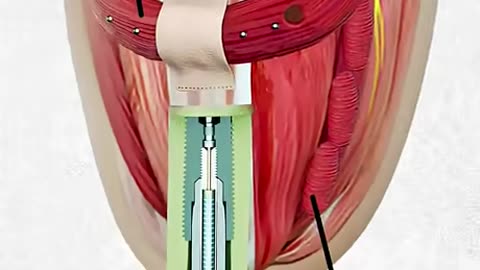 Bionic Knee