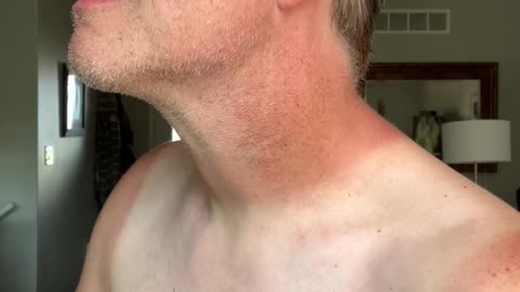 Skincare, Melanoma, and Summer Sun
