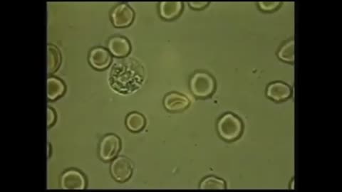 Krebs ist ein Parasit, eine Invasion von Mikroparasiten in unserem Körper.