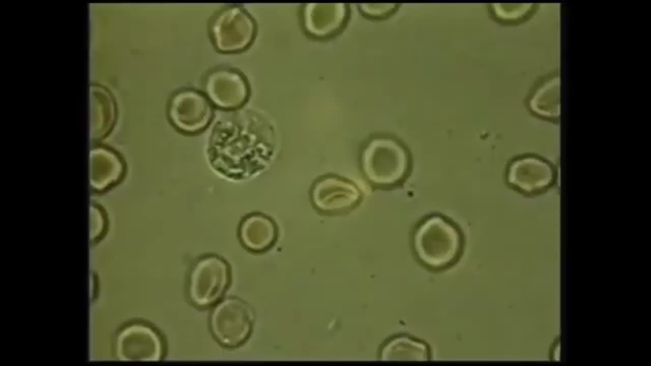 Krebs ist ein Parasit, eine Invasion von Mikroparasiten in unserem Körper.