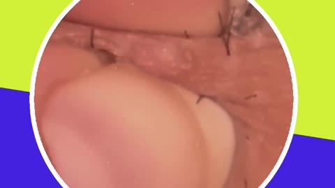 Pimple removal satisfying video (ASMR) #9 #shorts