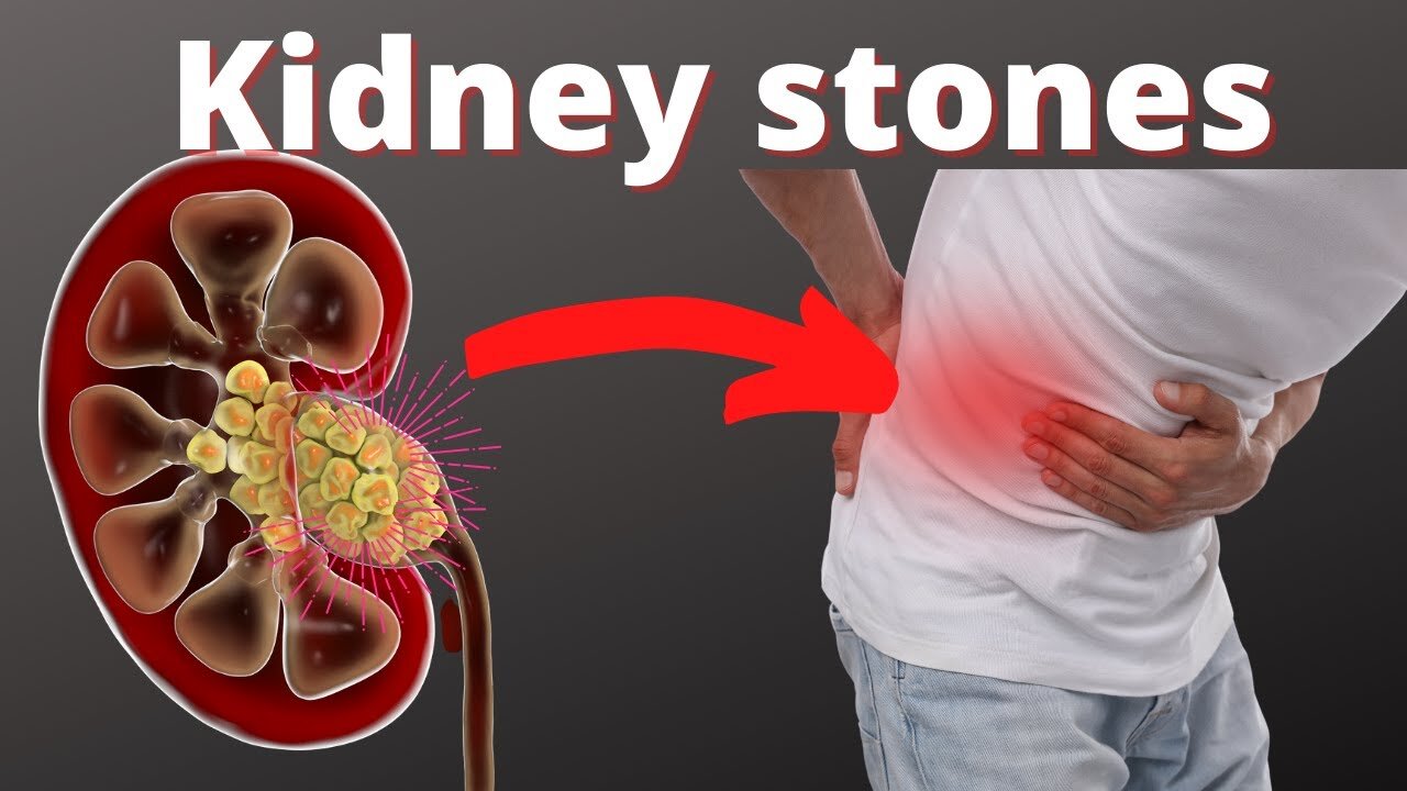 How To Get Rid of Kidney stones
