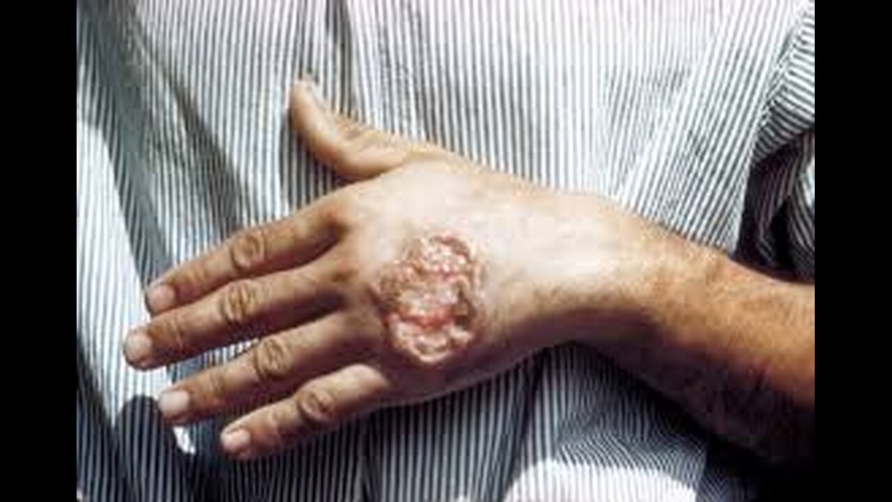 Grandes tueuses : La leishmaniose | Inserm [Flokossama]