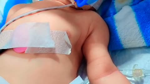 Newborn babies NICU TREATMENT