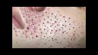 blackhead removal and Pimplepopper Spa relaxation #10124