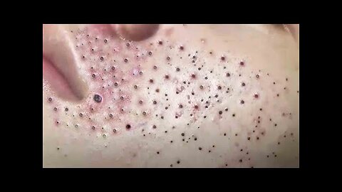 blackhead removal and Pimplepopper Spa relaxation #10124