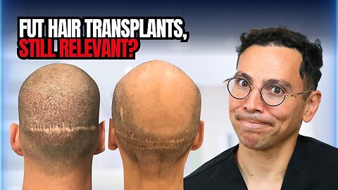 FUE vs FUT Hair Transplant – What They Don’t Tell You! (FAQ Explained)