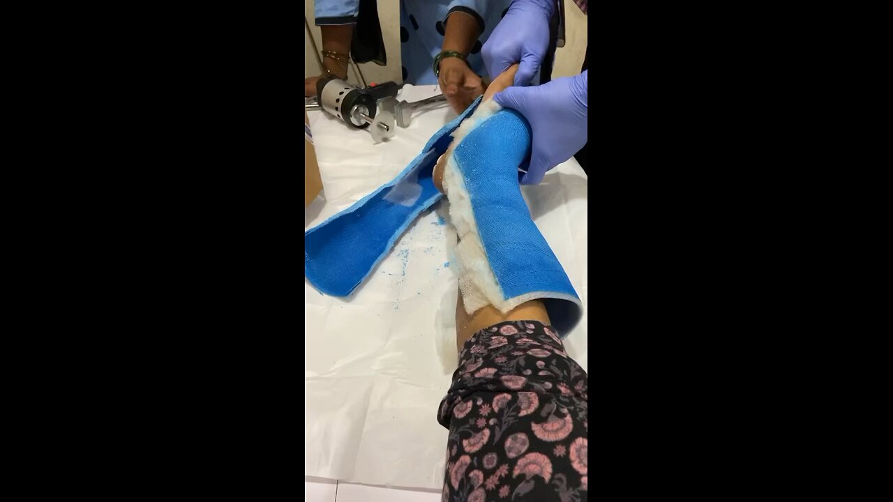 #latepost leg fracture during lock down | #sharmistha