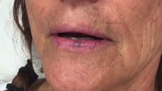 Flat warts a venous lake a blackhead and a biopsy For medical education NSFE