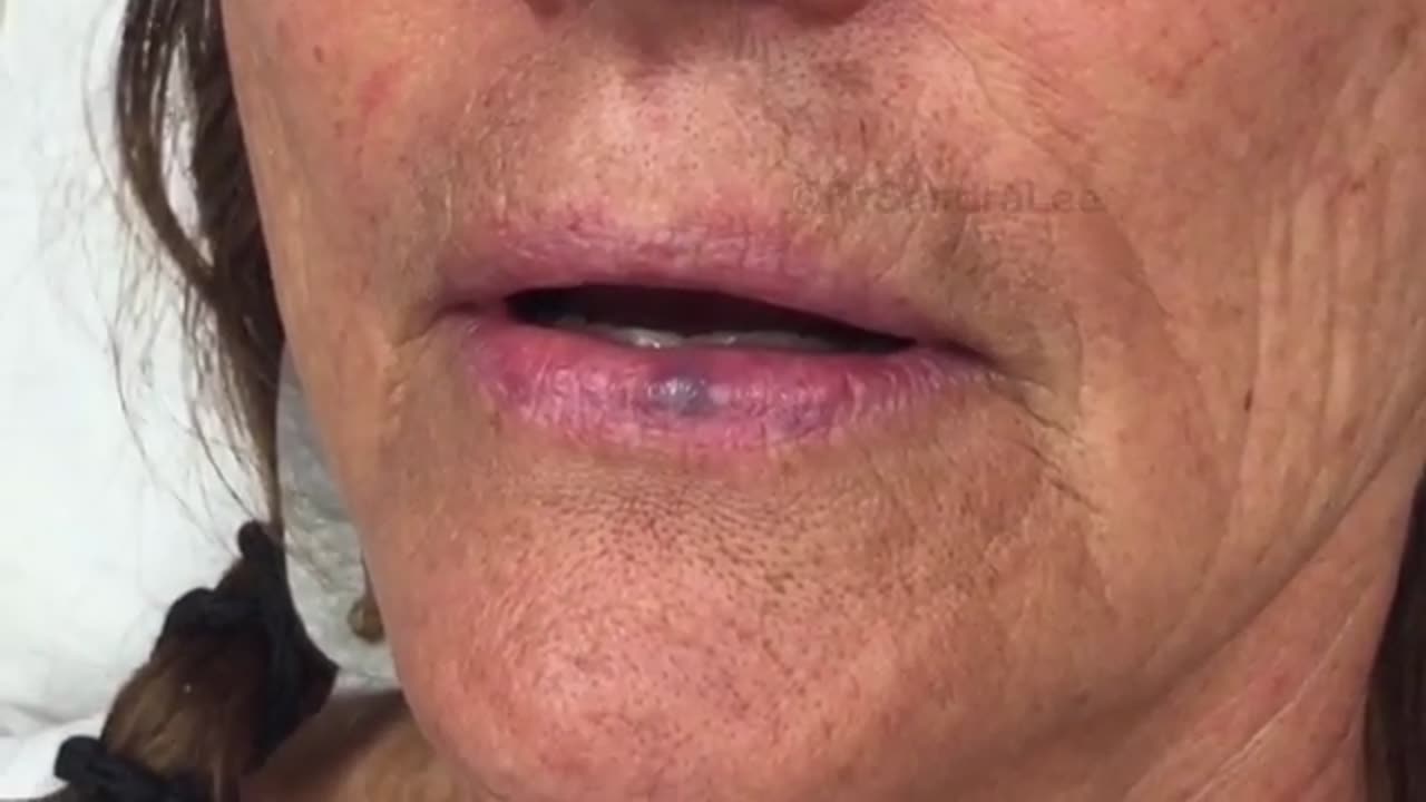 Flat warts a venous lake a blackhead and a biopsy For medical education NSFE