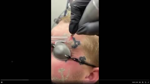 For all of the dummies that tattoo their face: Tattoo laser removal
