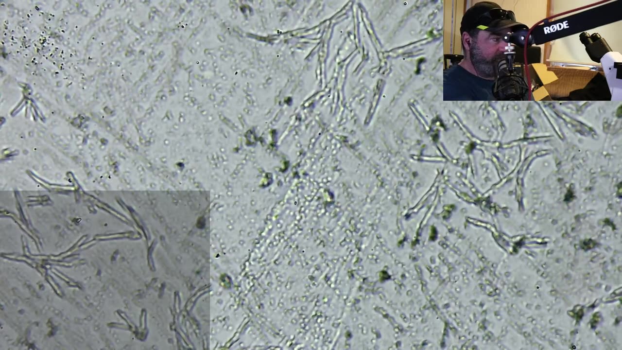 Amyloid Signals in Vax Injured (Fluorescent Microscopy)