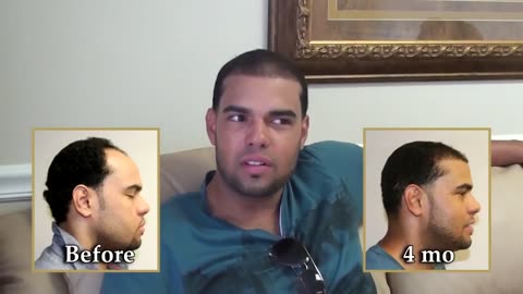 Youthful Hairline Rebuilt in Only 4 Months | Dr. Brett Bolton