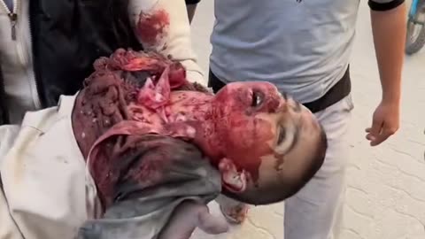 A child was martyred and injuries arrived at the Baptist Hospital (Graphic warning)