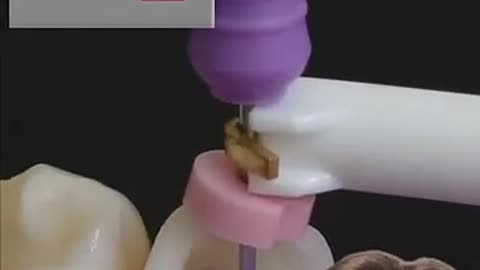 Must Watch: UNBELIEVABLE Cavity Filling - Explained