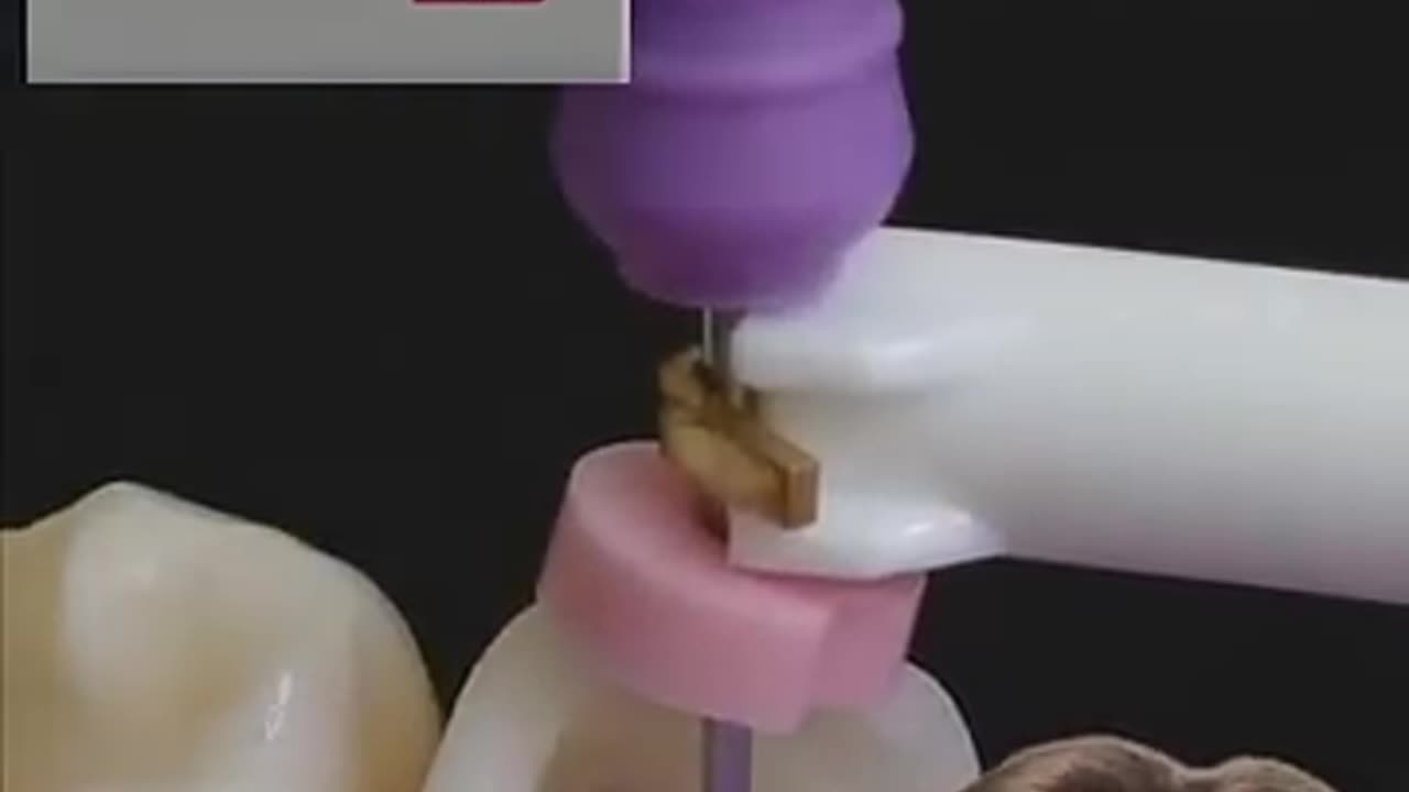 Must Watch: UNBELIEVABLE Cavity Filling - Explained