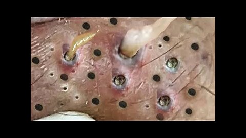 Blackheads Removal & Pimple Popper Cystic Acne Extraction