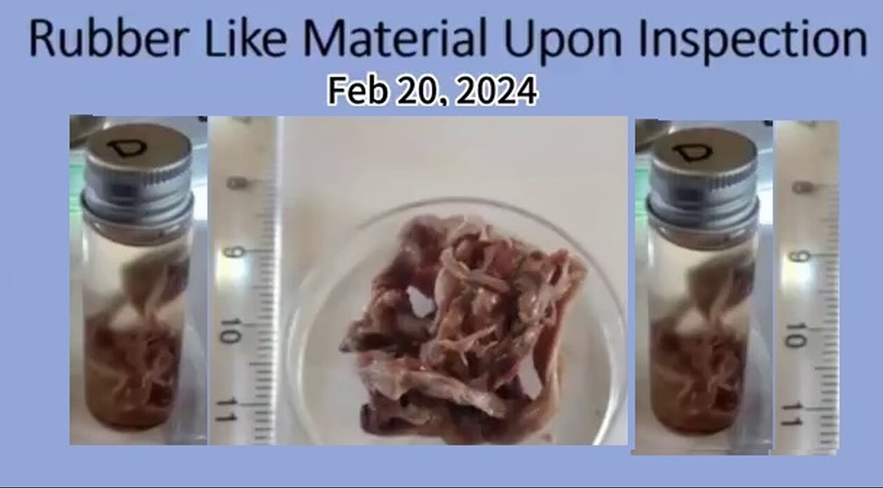 Dr.Ana Mihalcea: Nanotechnology causes self-assembling plastic-like clots to form in the blood