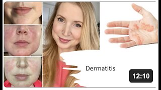 Dermatitis Natural Treatment