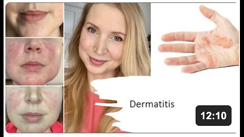 Dermatitis Natural Treatment