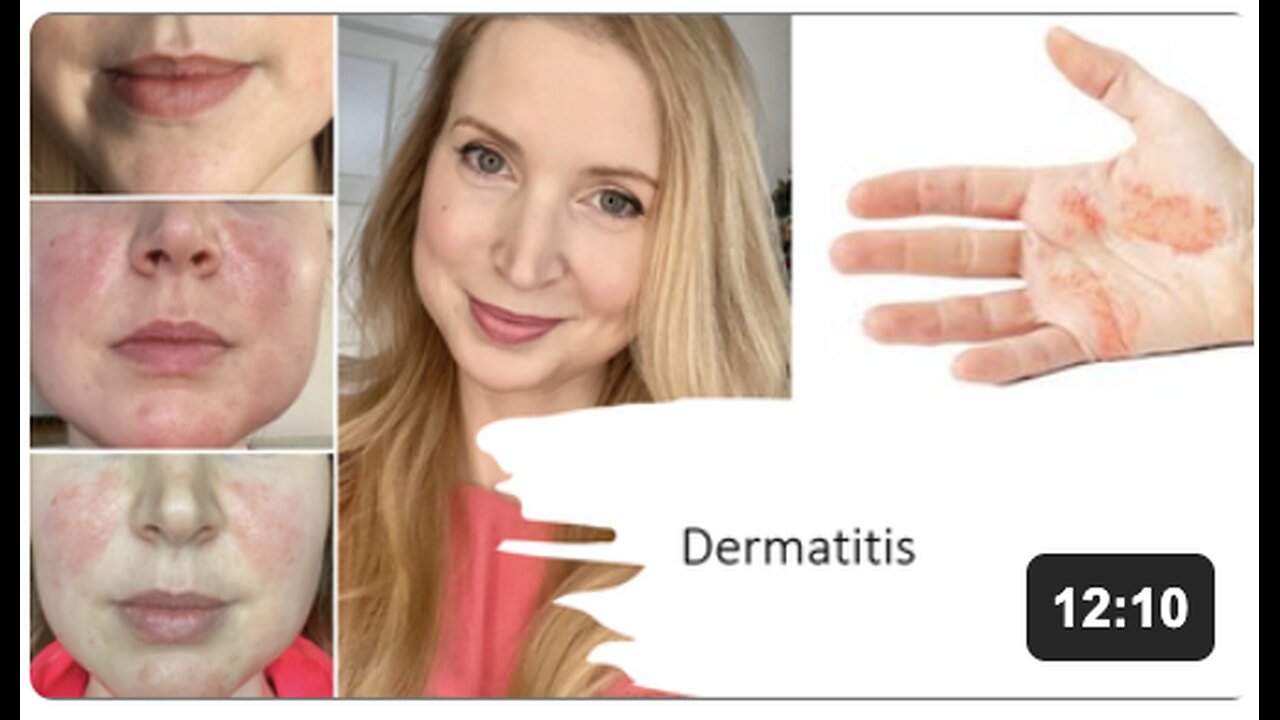 Dermatitis Natural Treatment