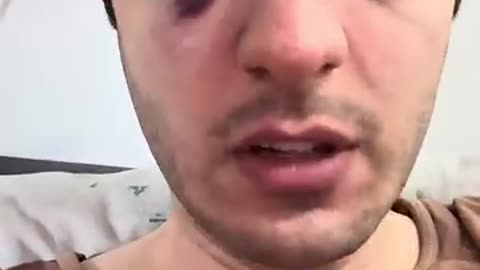 I Almost Lost My Eye in Metro in Rome