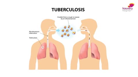 What is Pleural Effusion?