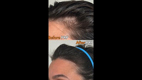 What is PRP?