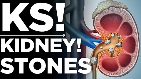 Kidney Stones: How to Prevent Pain & Discomfort | Medickpidia