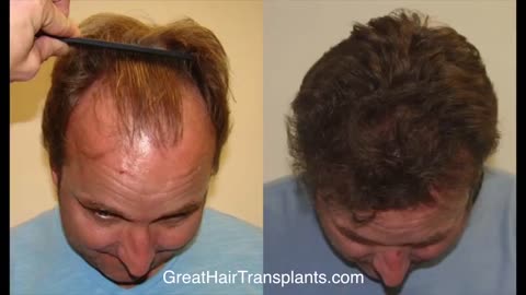 Dr. Brett Bolton Hair Implant Scar: Undetectable Results