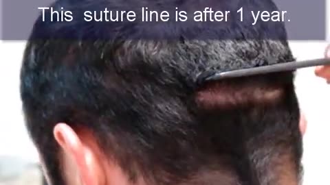 Dr. Brett Bolton Displays His Impressive Hair Transplant Suture Lines