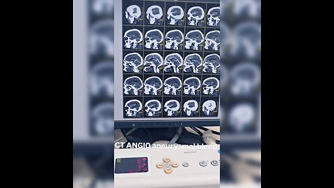 ct aneurysmal bleed
