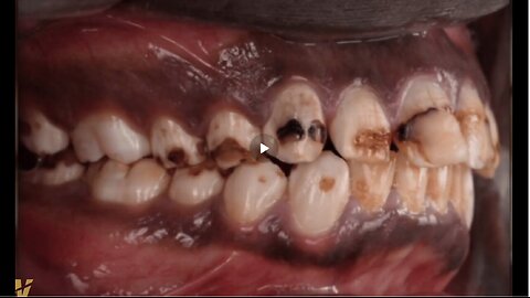 Attorney Michael Connett exposes decades of fluoride harm