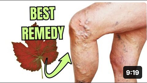 "Simple Solution for Venous Insufficiency: What Surgeons Won't Tell You!"