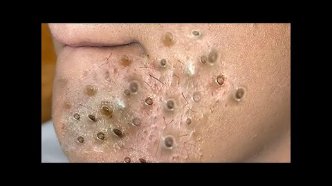 Blackheads Removal and Pimple Popper videos