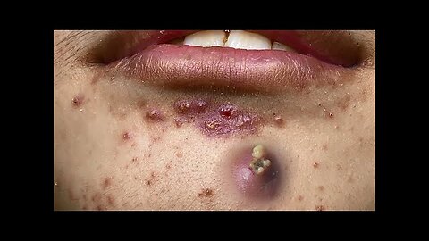 blackhead removal and Pimplepopper Spa relaxation #10117